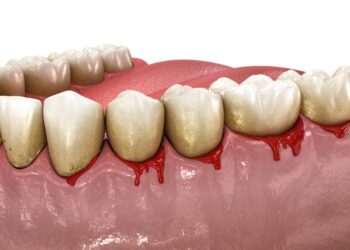 What Are the Benefits of Gum Grafting and Is It Right for You?