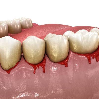 What Are the Benefits of Gum Grafting and Is It Right for You?