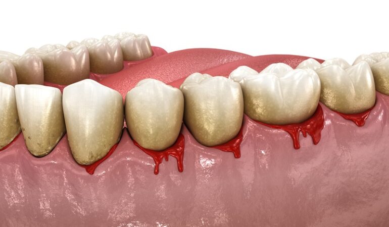 What Are the Benefits of Gum Grafting and Is It Right for You?