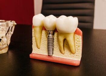 How Dental Implants Work: A Beginner’s Guide