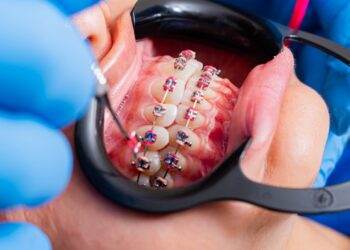 Signs That It’s Time to See an Orthodontist